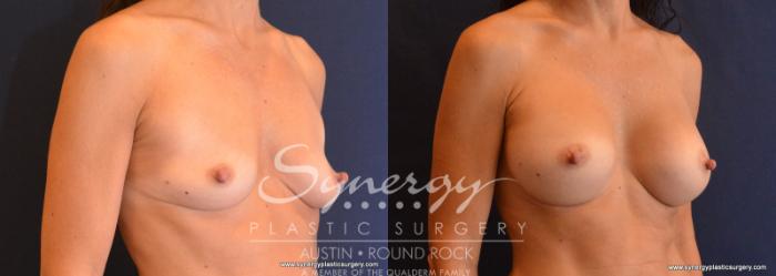 Before & After Breast Augmentation Case 620 View #4 View in Austin, TX