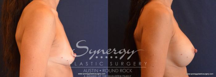 Before & After Breast Augmentation Case 620 View #5 View in Austin, TX