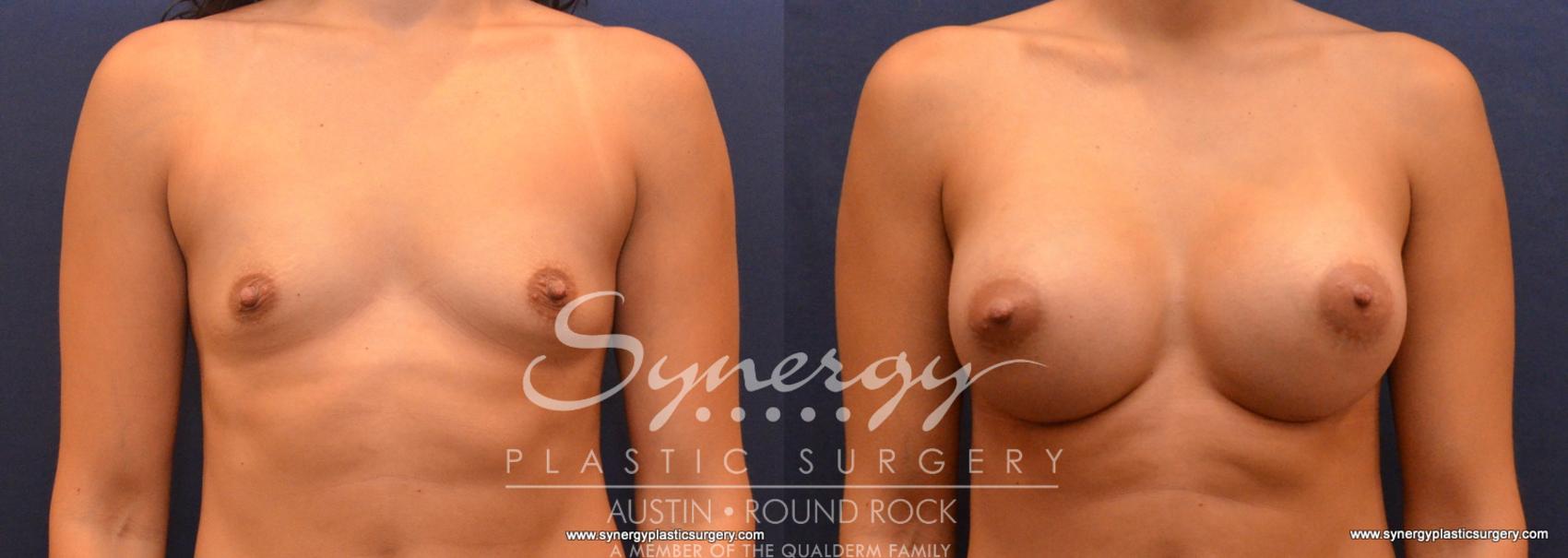 Before & After Breast Augmentation Case 622 View #1 View in Austin, TX