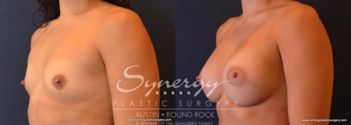 Before & After Breast Augmentation Case 622 View #2 View in Austin, TX