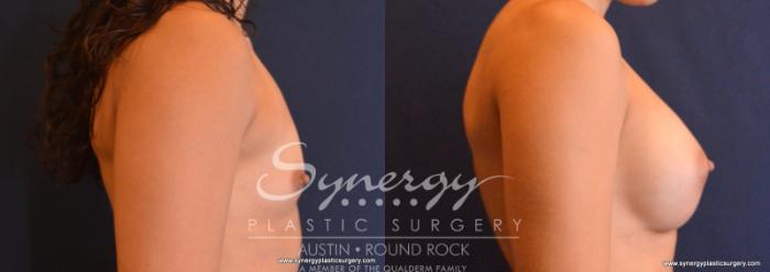 Before & After Breast Augmentation Case 622 View #3 View in Austin, TX