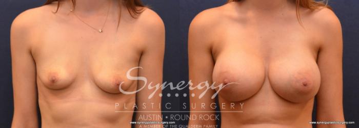 Before & After Breast Augmentation Case 623 View #1 View in Austin, TX
