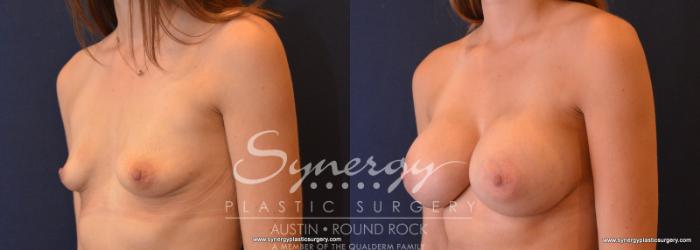 Before & After Breast Augmentation Case 623 View #2 View in Austin, TX