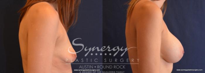 Before & After Breast Augmentation Case 623 View #5 View in Austin, TX