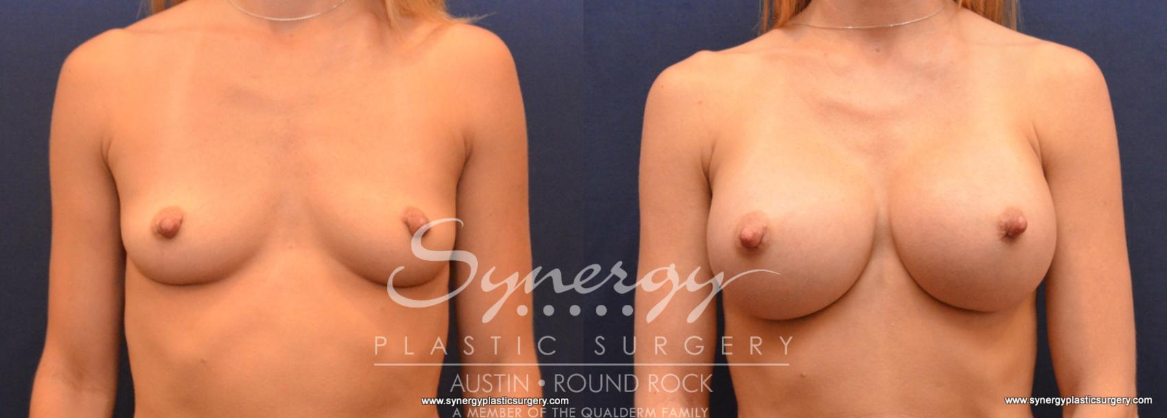 Before & After Breast Augmentation Case 625 View #1 View in Austin, TX