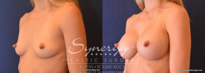 Before & After Breast Augmentation Case 625 View #2 View in Austin, TX