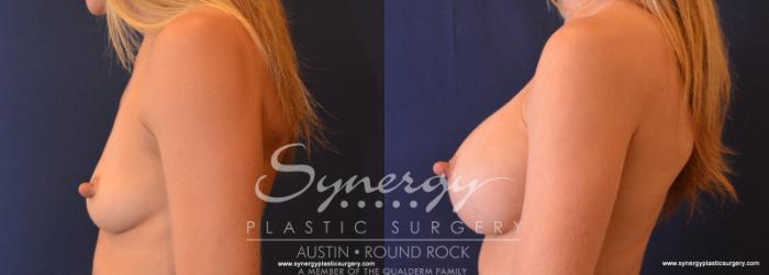 Before & After Breast Augmentation Case 625 View #3 View in Austin, TX