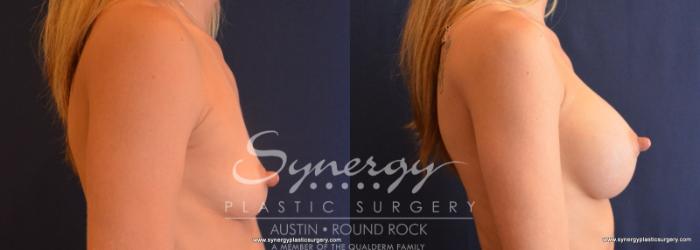Before & After Breast Augmentation Case 625 View #4 View in Austin, TX