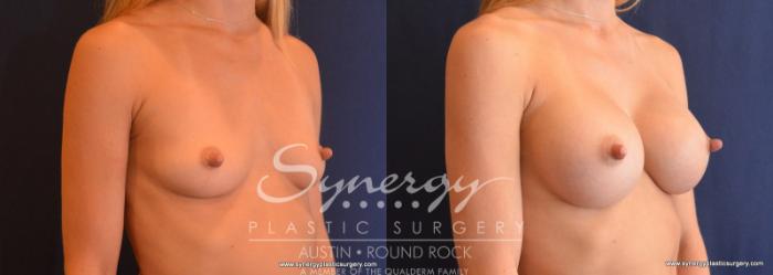 Before & After Breast Augmentation Case 625 View #5 View in Austin, TX