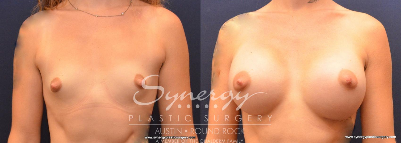 Before & After Breast Augmentation Case 626 View #1 View in Austin, TX