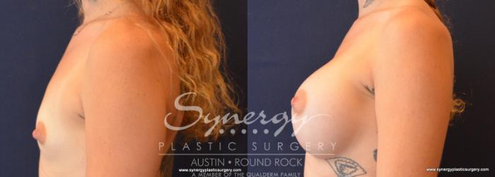 Before & After Breast Augmentation Case 626 View #3 View in Austin, TX