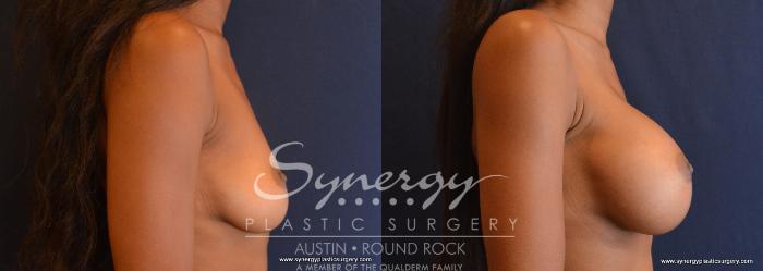 Before & After Breast Augmentation Case 633 View #2 View in Austin, TX