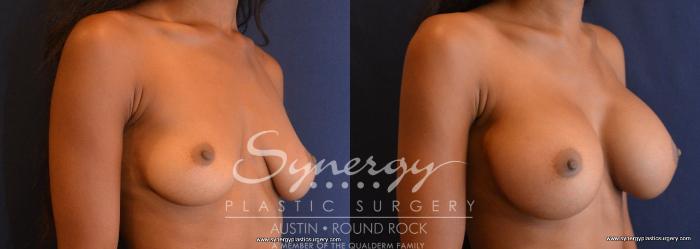 Before & After Breast Augmentation Case 633 View #3 View in Austin, TX