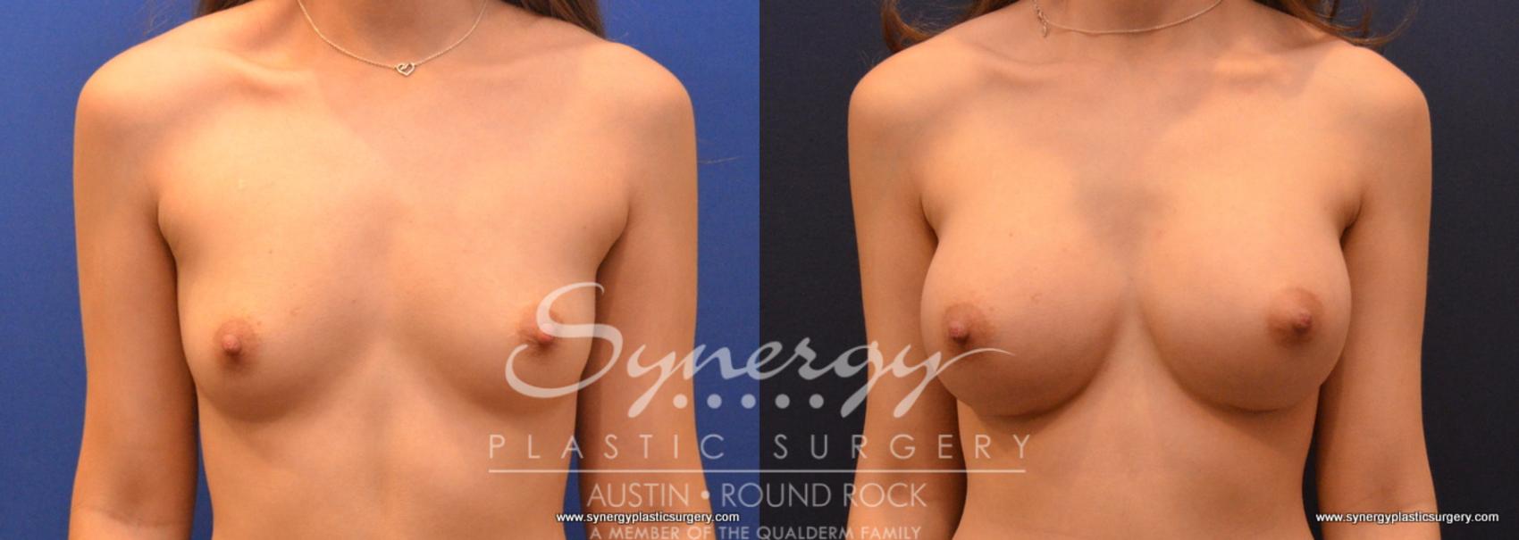 Before & After Breast Augmentation Case 634 View #1 View in Austin, TX