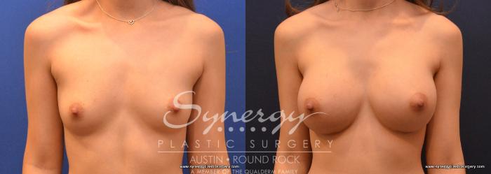 Before & After Breast Augmentation Case 634 View #1 View in Austin, TX