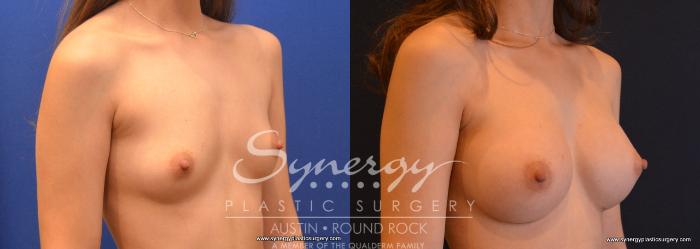Before & After Breast Augmentation Case 634 View #2 View in Austin, TX