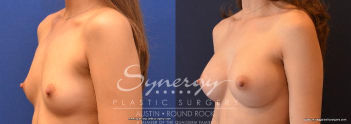 Before & After Breast Augmentation Case 634 View #4 View in Austin, TX