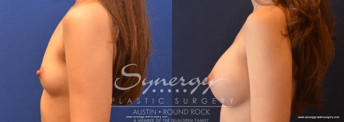 Before & After Breast Augmentation Case 634 View #5 View in Austin, TX