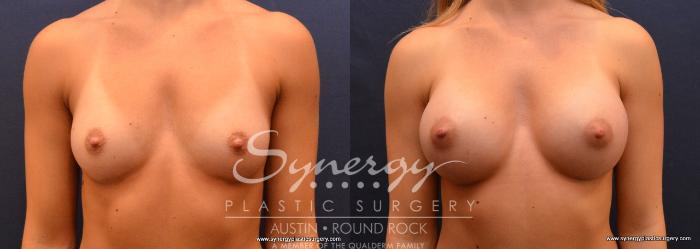 Before & After Breast Augmentation Case 636 View #1 View in Austin, TX