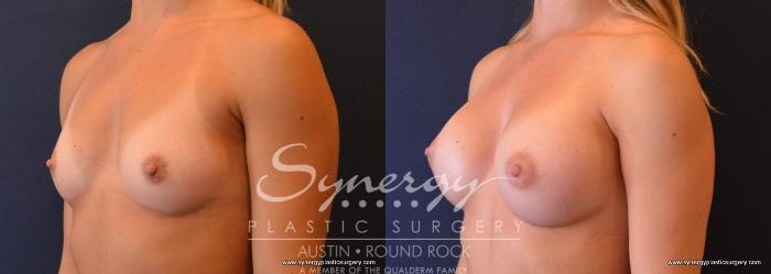 Before & After Breast Augmentation Case 636 View #2 View in Austin, TX