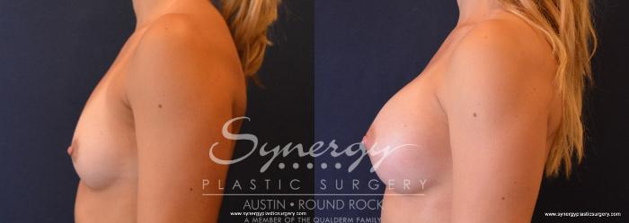 Before & After Breast Augmentation Case 636 View #3 View in Austin, TX