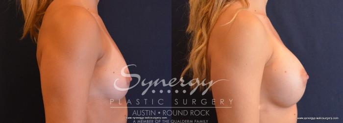 Before & After Breast Augmentation Case 636 View #5 View in Austin, TX