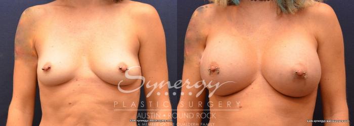 Before & After Breast Augmentation Case 637 View #1 View in Austin, TX