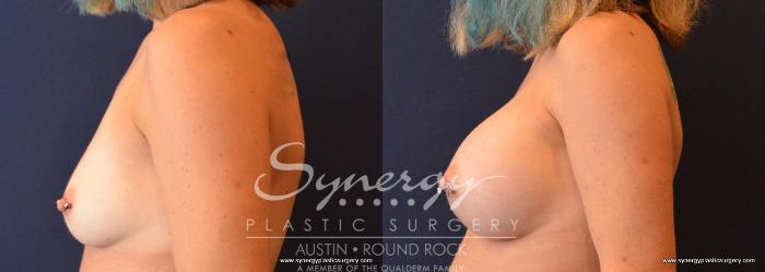 Before & After Breast Augmentation Case 637 View #2 View in Austin, TX