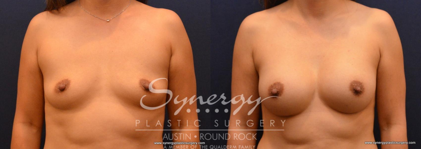 Before & After Breast Augmentation Case 639 View #1 View in Austin, TX