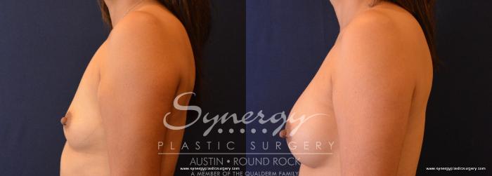 Before & After Breast Augmentation Case 639 View #3 View in Austin, TX