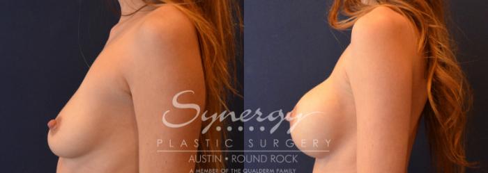 Before & After Breast Augmentation Case 641 View #3 View in Austin, TX