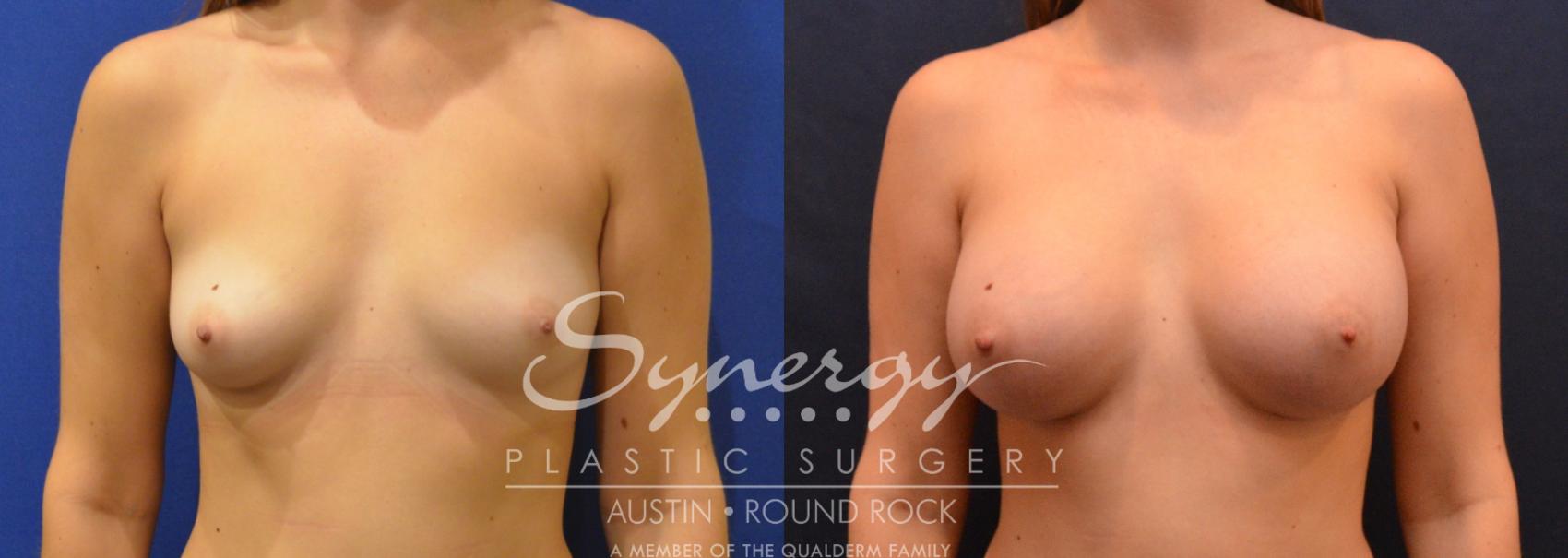Before & After Breast Augmentation Case 642 View #1 View in Austin, TX