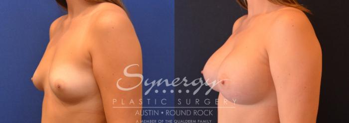 Before & After Breast Augmentation Case 642 View #2 View in Austin, TX