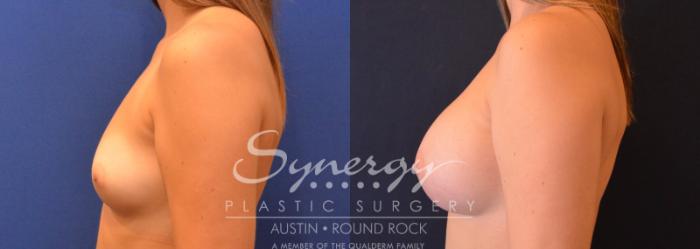 Before & After Breast Augmentation Case 642 View #3 View in Austin, TX