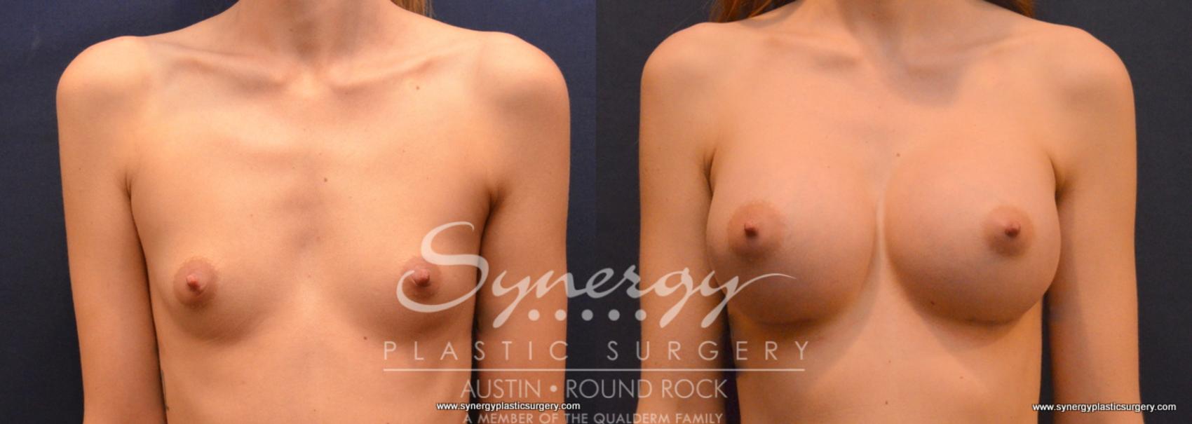 Before & After Breast Augmentation Case 645 View #1 View in Austin, TX