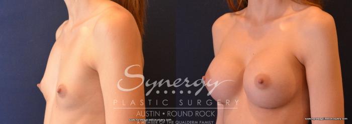 Before & After Breast Augmentation Case 645 View #2 View in Austin, TX