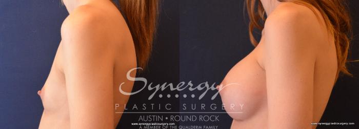 Before & After Breast Augmentation Case 645 View #3 View in Austin, TX