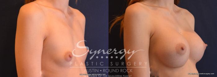 Before & After Breast Augmentation Case 645 View #4 View in Austin, TX
