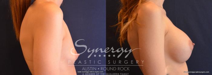 Before & After Breast Augmentation Case 645 View #5 View in Austin, TX