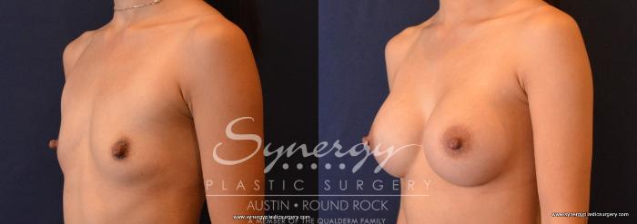 Before & After Breast Augmentation Case 646 View #2 View in Austin, TX