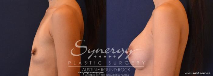Before & After Breast Augmentation Case 646 View #3 View in Austin, TX