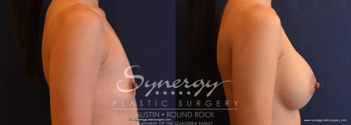 Before & After Breast Augmentation Case 646 View #4 View in Austin, TX