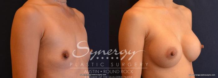 Before & After Breast Augmentation Case 646 View #5 View in Austin, TX