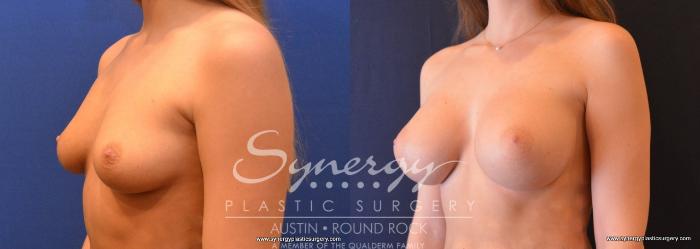 Before & After Breast Augmentation Case 649 View #2 View in Austin, TX