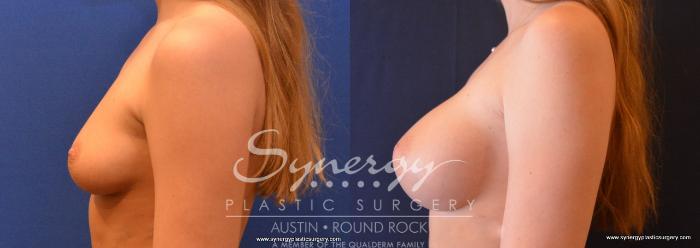 Before & After Breast Augmentation Case 649 View #3 View in Austin, TX