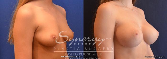 Before & After Breast Augmentation Case 649 View #4 View in Austin, TX