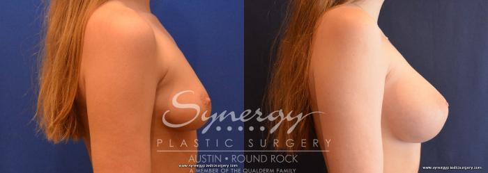 Before & After Breast Augmentation Case 649 View #5 View in Austin, TX
