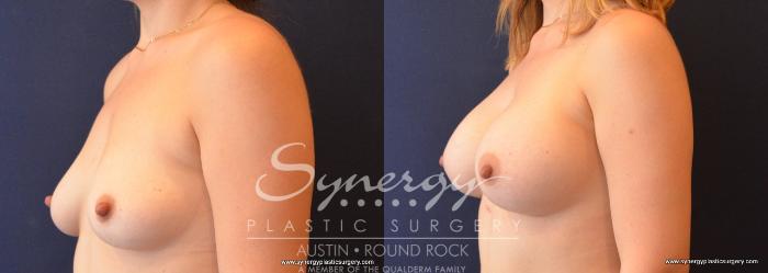 Before & After Breast Augmentation Case 650 View #2 View in Austin, TX