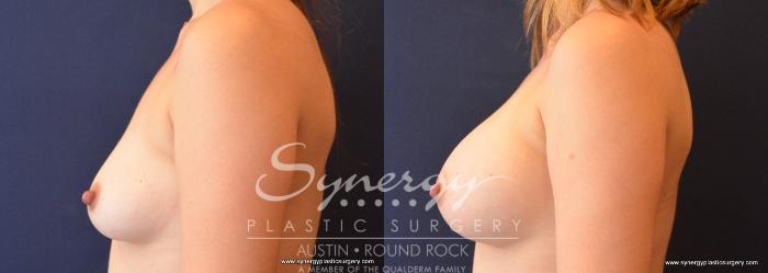 Before & After Breast Augmentation Case 650 View #3 View in Austin, TX