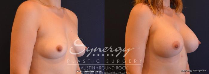 Before & After Breast Augmentation Case 650 View #4 View in Austin, TX